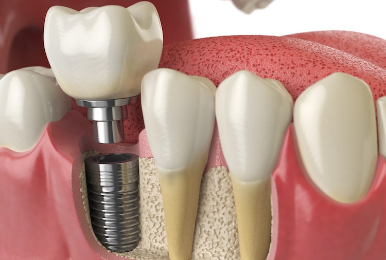 Dental Implants Novi Oaks Dental