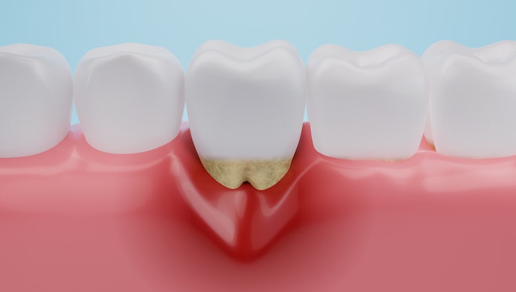 Gum Treatment Novi Oaks Dental