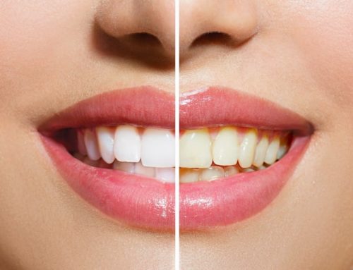 How to Fix Yellow Teeth – Ames Dentistry Guide