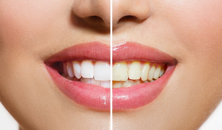 Teeth Whitening Novi Oaks Dental