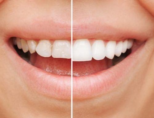 How long do porcelain veneers last?