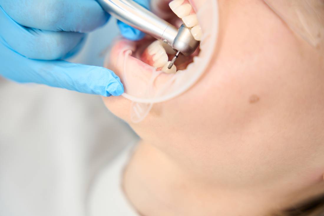 Close up of dental procedure.