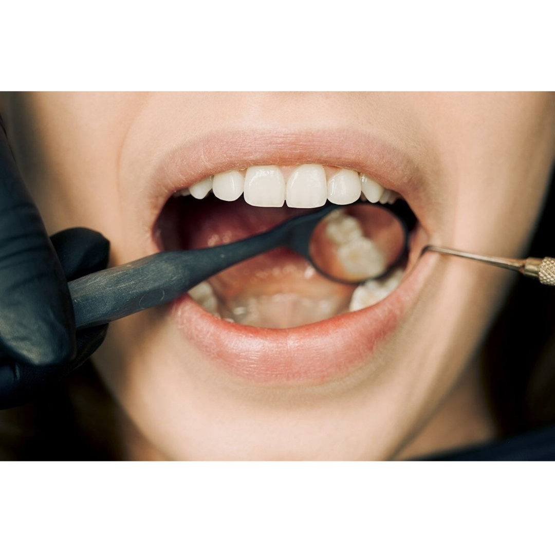 View of an open mouth with a dental tool and small dental mirror inside.