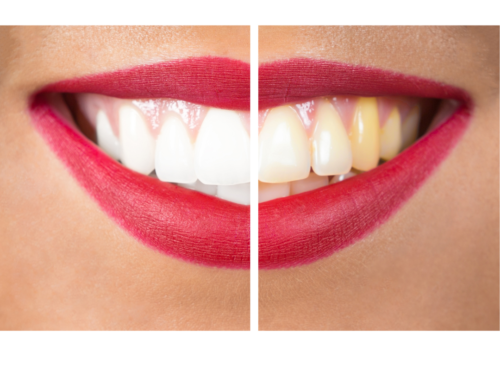 What is the Most Popular Cosmetic Dental Procedure?