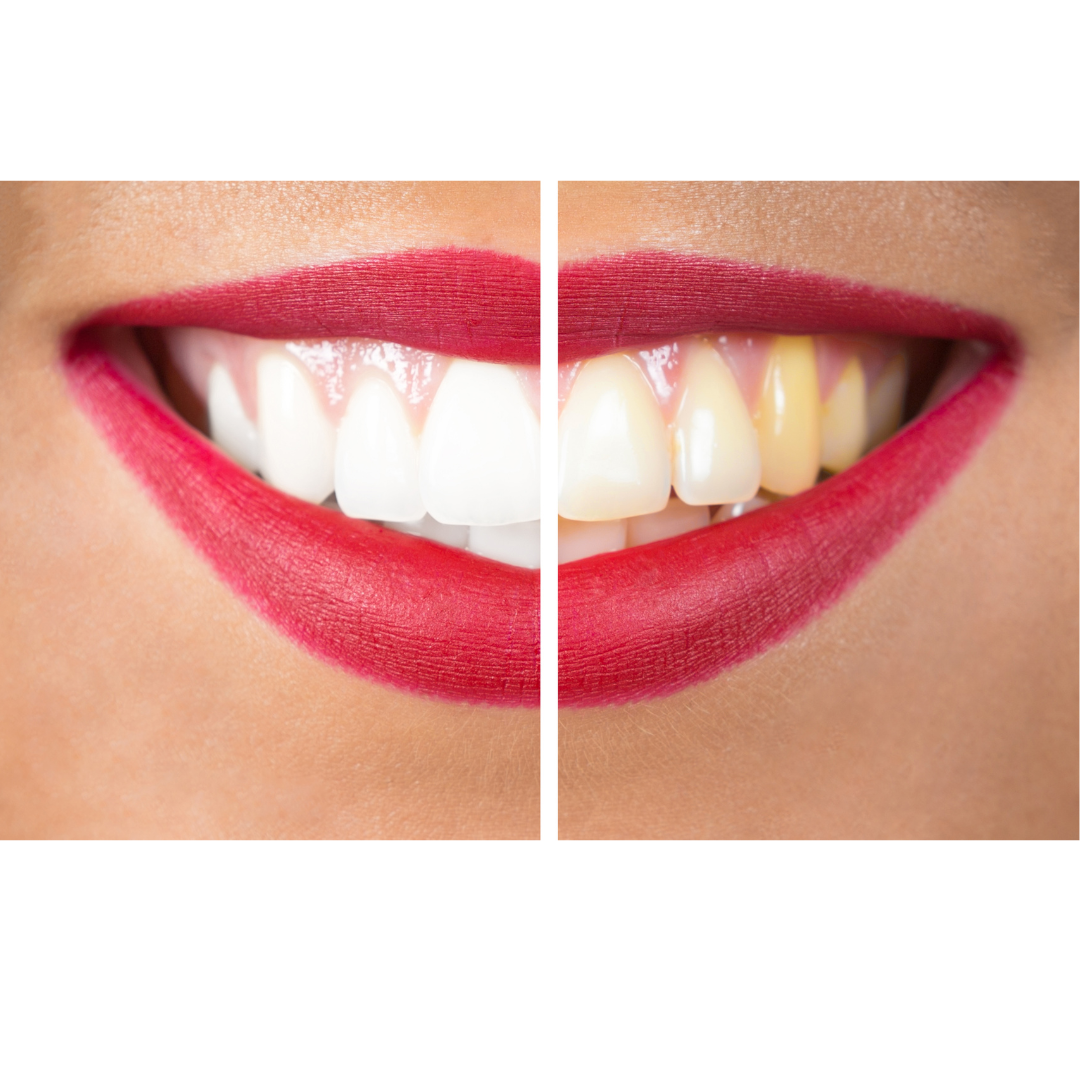 Split image of a smile showing the before and after of teeth whitening.