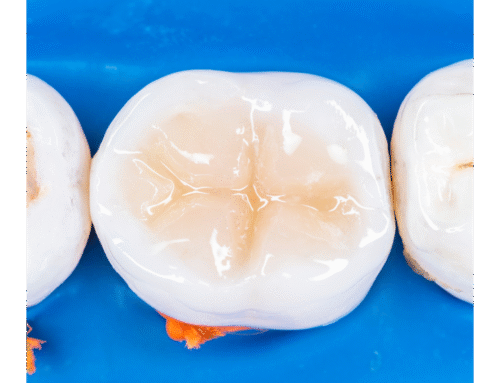 How to Know If You Need a Root Canal (Or Just a Filling)