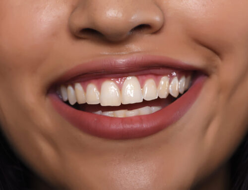 What Causes a Cavity in a Front Tooth? Possible Treatments and Precautions
